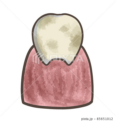 汚れた歯と汚れた歯茎　汚い歯 85651012