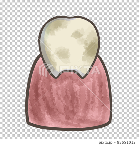 汚れた歯と汚れた歯茎　汚い歯 85651012