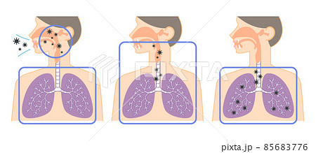 上気道から下気道へ移動するウイルスの説明イラスト（鼻・喉・肺の図表） 85683776