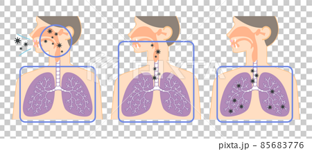上気道から下気道へ移動するウイルスの説明イラスト（鼻・喉・肺の図表） 85683776