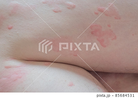 蕁麻疹 85684531