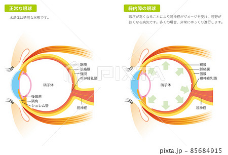 緑内障の眼球（カラー） 85684915