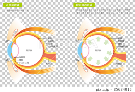 緑内障の眼球（カラー） 85684915