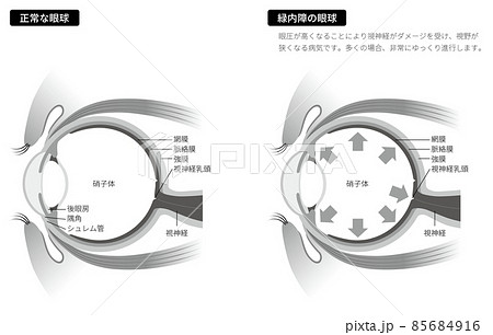 緑内障の眼球（白黒） 85684916