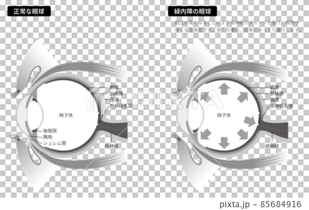 緑内障の眼球（白黒） 85684916