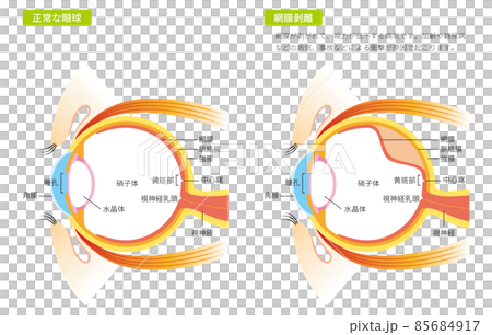 網膜剥離の眼球(カラー) 網膜剥離の眼球(カラー) 85684917