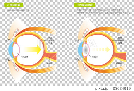 白內障眼球(彩色) 白內障眼球(彩色) 85684919