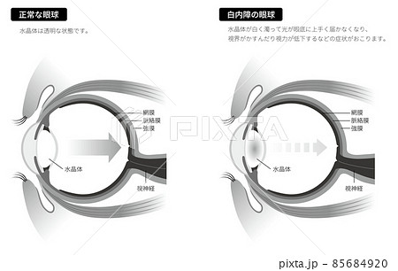 白内障の眼球（白黒） 85684920