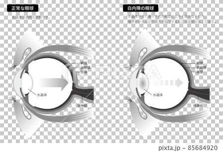 白内障の眼球（白黒） 85684920