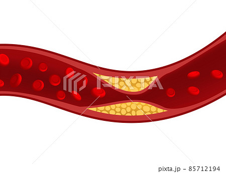 Cholesterol artery thrombosis micro vascular desease. Arteriosclerosis blood vector atherosclerosis 85712194