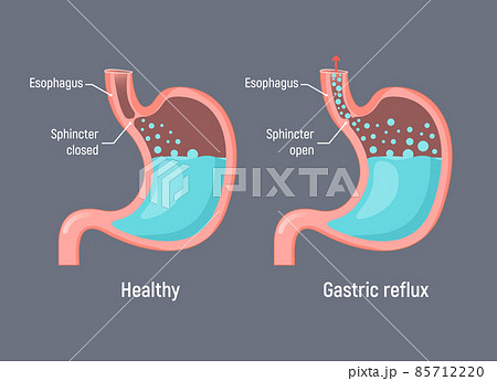 Esophageal gastric reflux acid indigestion. Gastrointestial stomach heartburn gerd gastric reflux 85712220