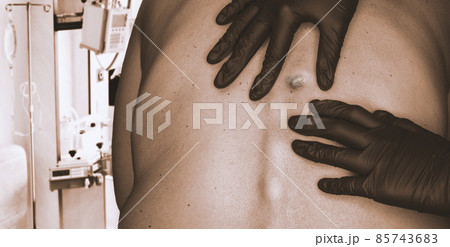Doctor in medical gloves examines growths on a woman's skin. Skin cancer diagnostics. Doctor in medical gloves examines growths on a woman's skin. Skin cancer diagnostics. 85743683