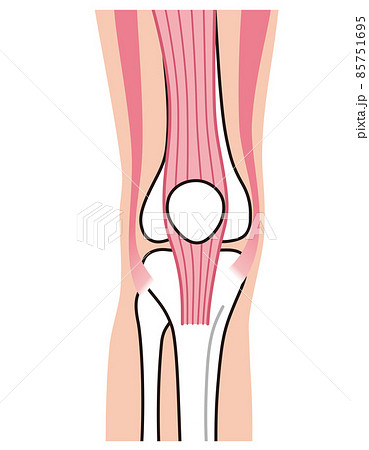 膝関節 説明図 スポーツ障害 ジャンパー膝 膝関節 説明図 スポーツ障害 ジャンパー膝 85751695