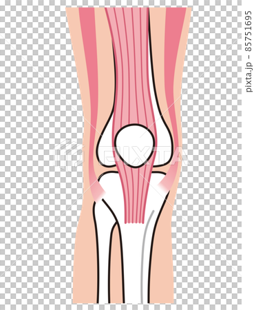 膝関節 説明図 スポーツ障害 ジャンパー膝 膝関節 説明図 スポーツ障害 ジャンパー膝 85751695