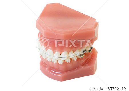 歯科矯正　模型　白背景イメージ 85760140