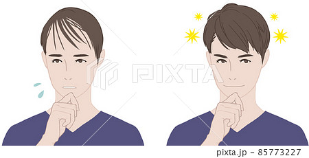 薄毛に悩む男性とフサフサの男性 85773227