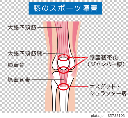 Knee joint explanatory diagram Sports injury Jumper knee Knee joint explanatory diagram Sports injury Jumper knee 85782103
