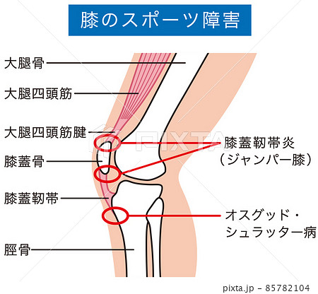 膝関節　説明図　スポーツ障害　ジャンパー膝 85782104