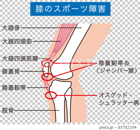 膝関節　説明図　スポーツ障害　ジャンパー膝 85782104