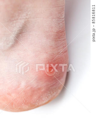 Small unpopped blister on heel, isolated on white background, close-up with selective focus. Small unpopped blister on heel, isolated on white background, close-up with selective focus. 85816811