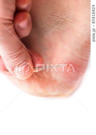 Blister on heel gets pricked with needle to burst it on white background, close-up with selective focus. 85816824