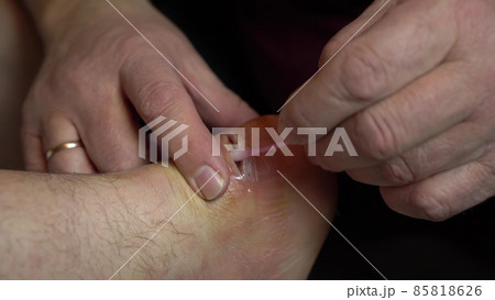 Wound treatment from suppuration with a cotton swab. Surgical incision of the ankle joint for inflammation. Wound treatment from suppuration with a cotton swab. Surgical incision of the ankle joint for inflammation. 85818626