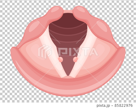 Illustration of vocal cord nodule Illustration of vocal cord nodule 85822976