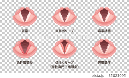 Illustration material set of laryngeal diseases 85823095