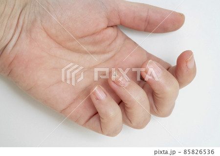 nail fungus infection on hand finger of white woman nail fungus infection on hand finger of white woman 85826536