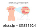 Pectoralis muscle trigger point. Myofascial release physical therapy, anatomy, medicine. For topics like sport, chronic pain, massage 85835924