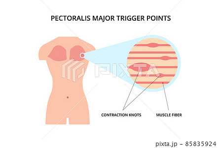 Pectoralis muscle trigger point. Myofascial release physical therapy, anatomy, medicine. For topics like sport, chronic pain, massage 85835924