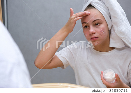 teenage girl . Acne. Care for problem skin teenage girl . Acne. Care for problem skin 85850711
