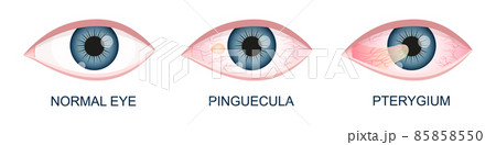 Eye healthy, with pinguecula and pterygium growing onto cornea. Conjunctival degeneration. Eye disease. Human organ of vision with pathology 85858550