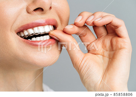 A young woman does a home teeth whitening procedure. Whitening tray with gel A young woman does a home teeth whitening procedure. Whitening tray with gel 85858806