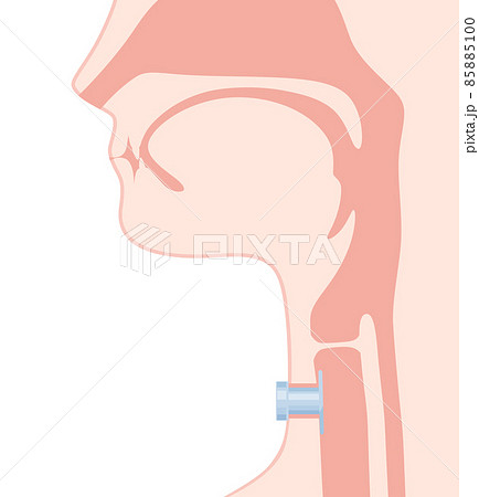 レティナのイラスト_気管カニューレ_矢状断 レティナのイラスト_気管カニューレ_矢状断 85885100