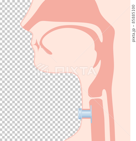 レティナのイラスト_気管カニューレ_矢状断 レティナのイラスト_気管カニューレ_矢状断 85885100
