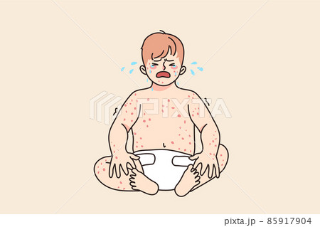 Unhappy baby crying suffer from eczema disease  85917904