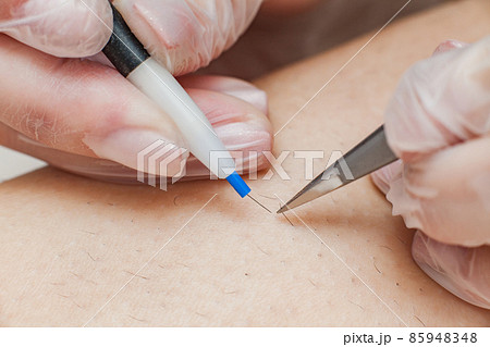 The process of permanent unwanted hair removal, using an electroepilation device and tweezers. The process of permanent unwanted hair removal, using an electroepilation device and tweezers. 85948348