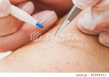 The process of permanent unwanted hair removal, using an electroepilation device and tweezers. The process of permanent unwanted hair removal, using an electroepilation device and tweezers. 85948353