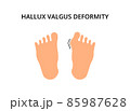 Foot with hallux valgus deformity. Bunion, problem, orthopedics. For topics like symptom, bone, podiatry 85987628