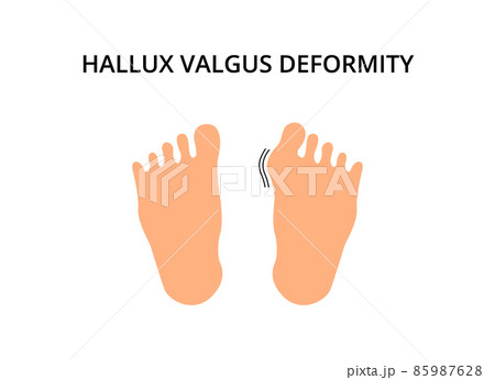 Foot with hallux valgus deformity. Bunion, problem, orthopedics. For topics like symptom, bone, podiatry 85987628