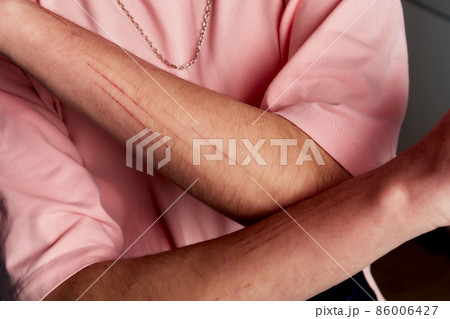 The skin condition after cat scratch and bite of veterinary surgeon hand during physical examination in a veterinary clinic. The skin condition after cat scratch and bite of veterinary surgeon hand during physical examination in a veterinary clinic. 86006427