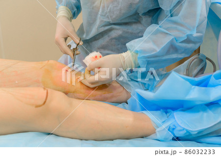 Cosmetic surgery liposuction. The process of removing fat on the legs of a fat woman. Without face, unrecognizable patient. 86032233