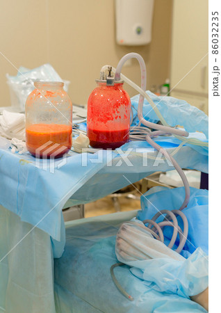 Bottle of liquid fat from liposuction. Slimming through plastic surgery. The figure of a dream. 86032235