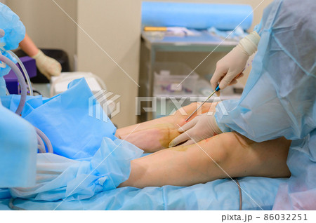 Cosmetic surgery liposuction. The process of removing fat on the legs of a fat woman. Without face, unrecognizable patient. 86032251