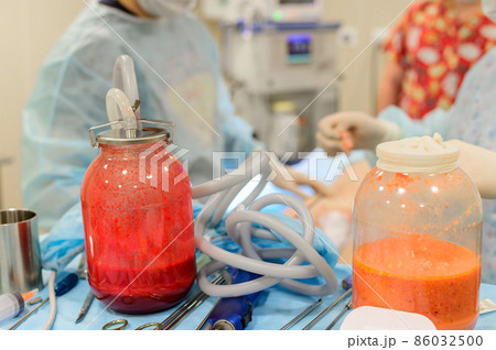 Bottle of liquid fat from liposuction. Slimming through plastic surgery. The figure of a dream. 86032500