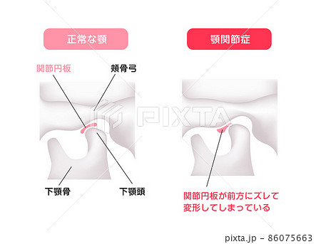 正常な顎（あご）と顎関節症の顎 / 間接円板の違い ベクターイラスト  86075663