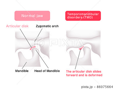 正常な顎（あご）と顎関節症の顎 / 間接円板の違い ベクターイラスト (英語) 86075664