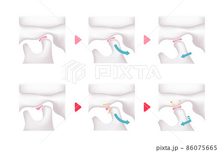 正常な顎（あご）と顎関節症の顎 / 顎開閉時の比較ベクターイラスト (文字なし) 86075665
