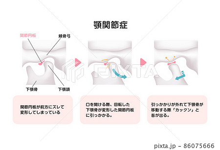顎関節症の発生の仕組みと原因 ベクターイラスト 顎関節症の発生の仕組みと原因 ベクターイラスト 86075666
